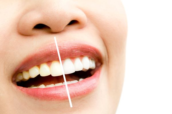 Teeth Whitening in Mississauga